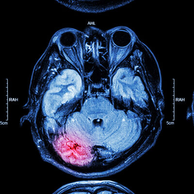 Sport-Related Concussions: Modern Athlete Care